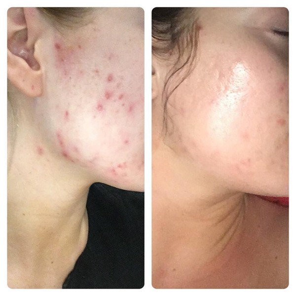 Acne treatment Photo